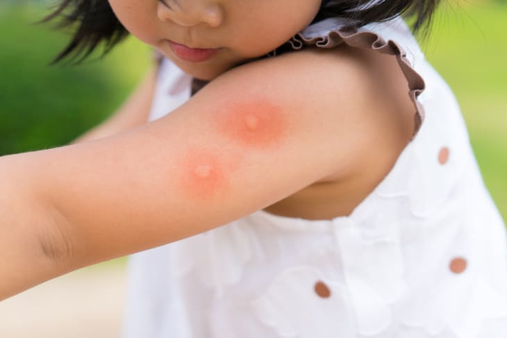 Girl with two red mosquito bites on her arm