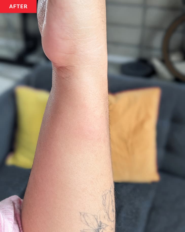 bug bite after being treated with quitch bug bite relief patch