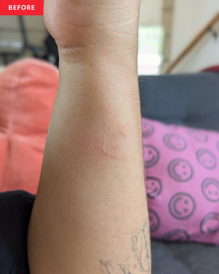 bug bite being treated with quitch bug bite relief patch