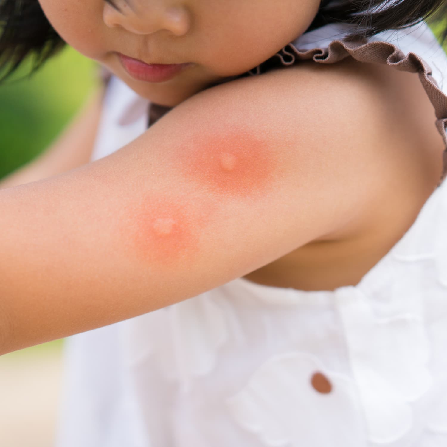 Mosquito bites on toddlers deals